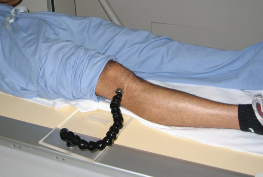 Knee replacement application of OrthoMark calibration and marking device