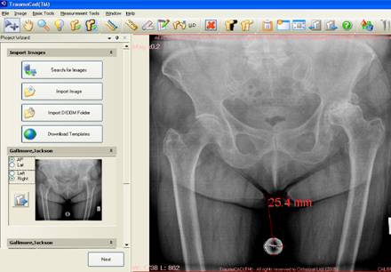Automatic calibration of bone size