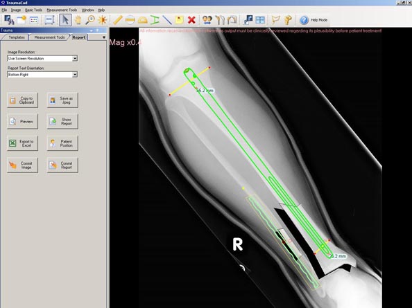 a distal Tibia and Fibula